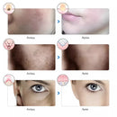 Máscara Facial LED Anti-Idade e Rejuvenescimento - LumiSkin™